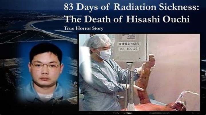 Hisashi Ouchi's Skin: A Tragic Tale Of Radiation Exposure